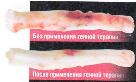 Генная терапия против травм