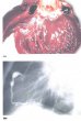 Болезнь Кавасаки