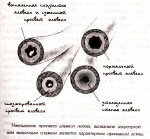 АСТМА