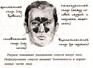 КАТАРАЛЬНОЕ ВОСПАЛЕНИЕ И СИНУСИТ