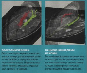 Лечение комы
